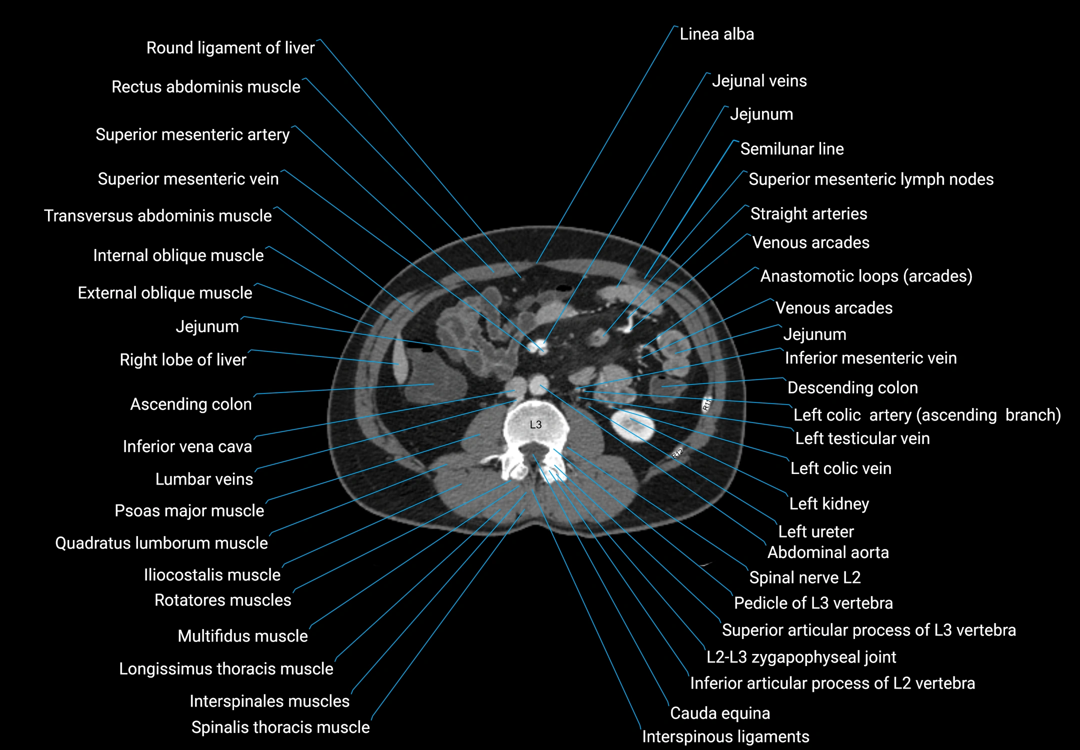 CT male pelvis axial cross sectional anatomy labelled radiology image -00087.webp